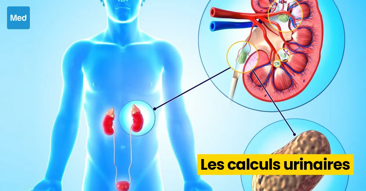 Les calculs urinaires : causes, symptômes et traitements
